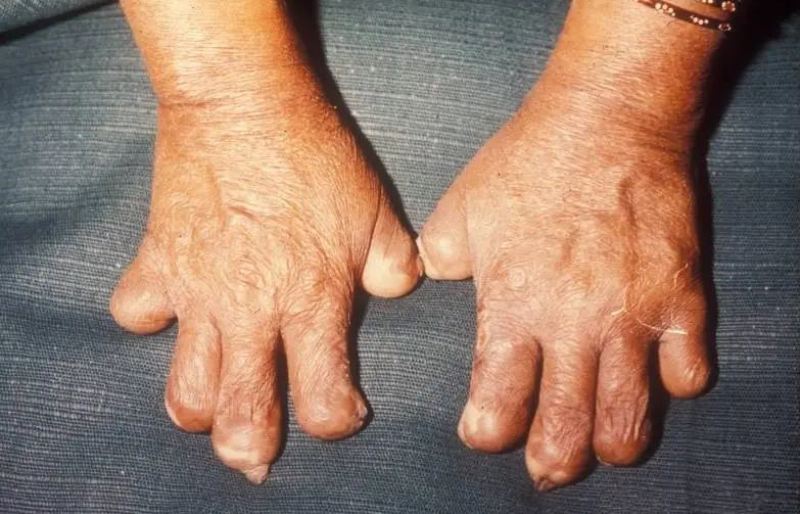 नवलपरासी पूर्वमा ४० जना कोष्ठ रोगी उपचाररत  