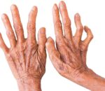 नवलपरासी पूर्वमा ३० जना कोष्ठ रोगी उपचाररत